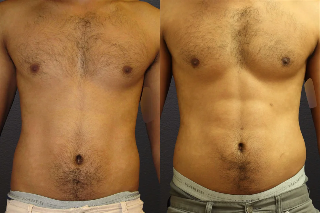 66912-ANTERIOR combined