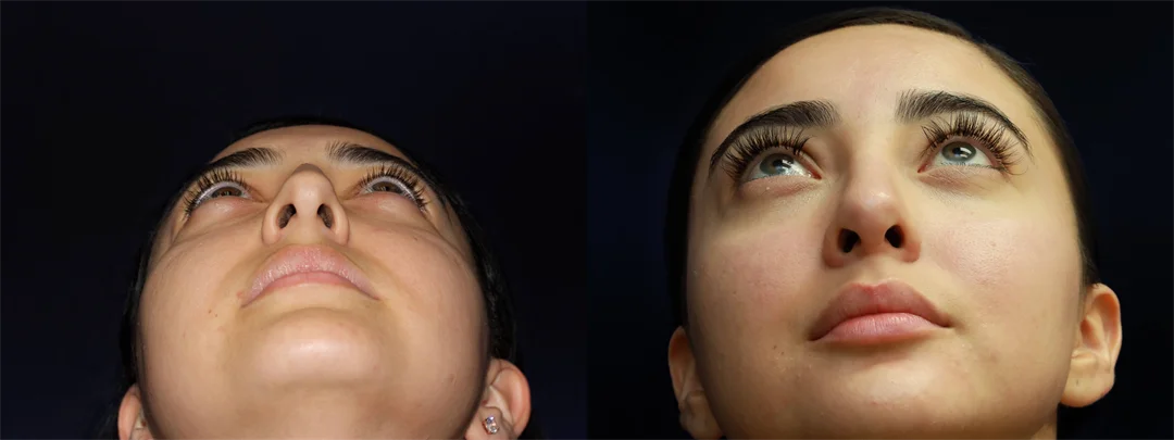 67115-NASAL BASE combined