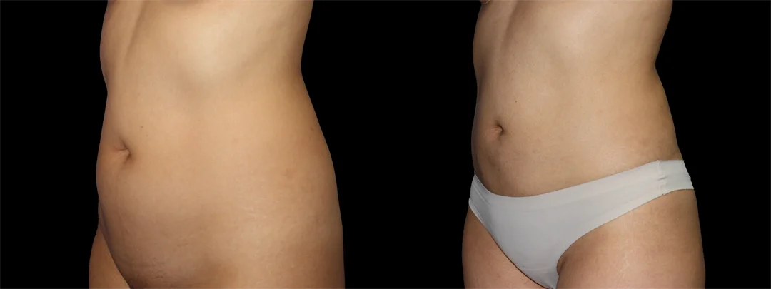 67170-Left oblique combined
