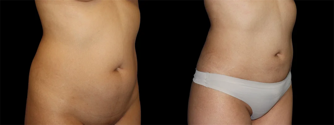 67170-Right oblique combined
