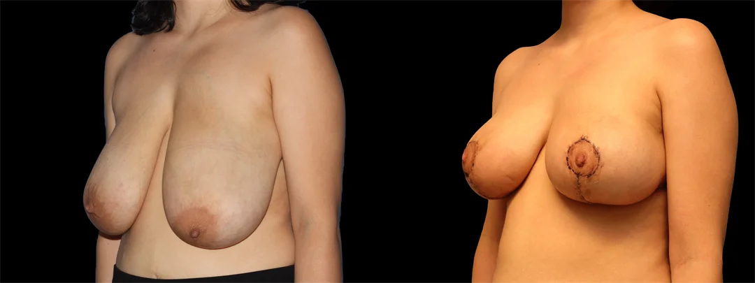 67180-LEFT OBLIQUE combined