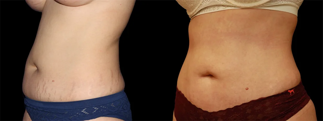 67191-Left oblique combined
