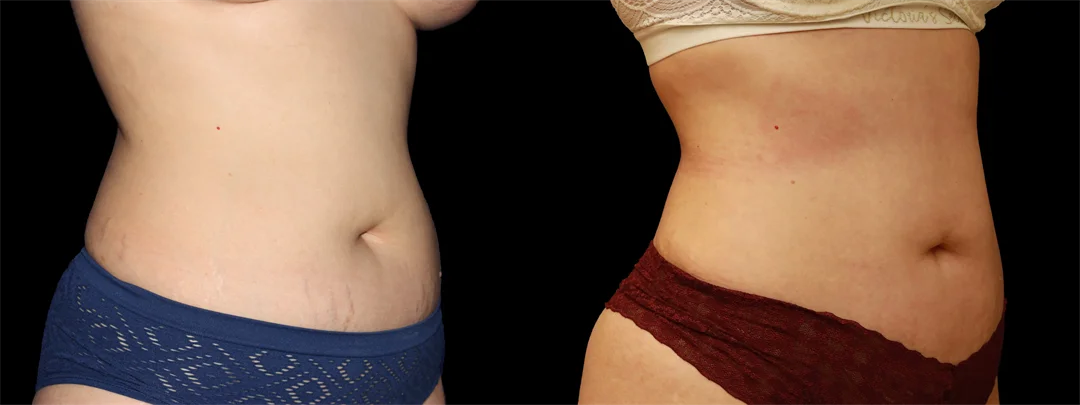 67191-Right oblique combined
