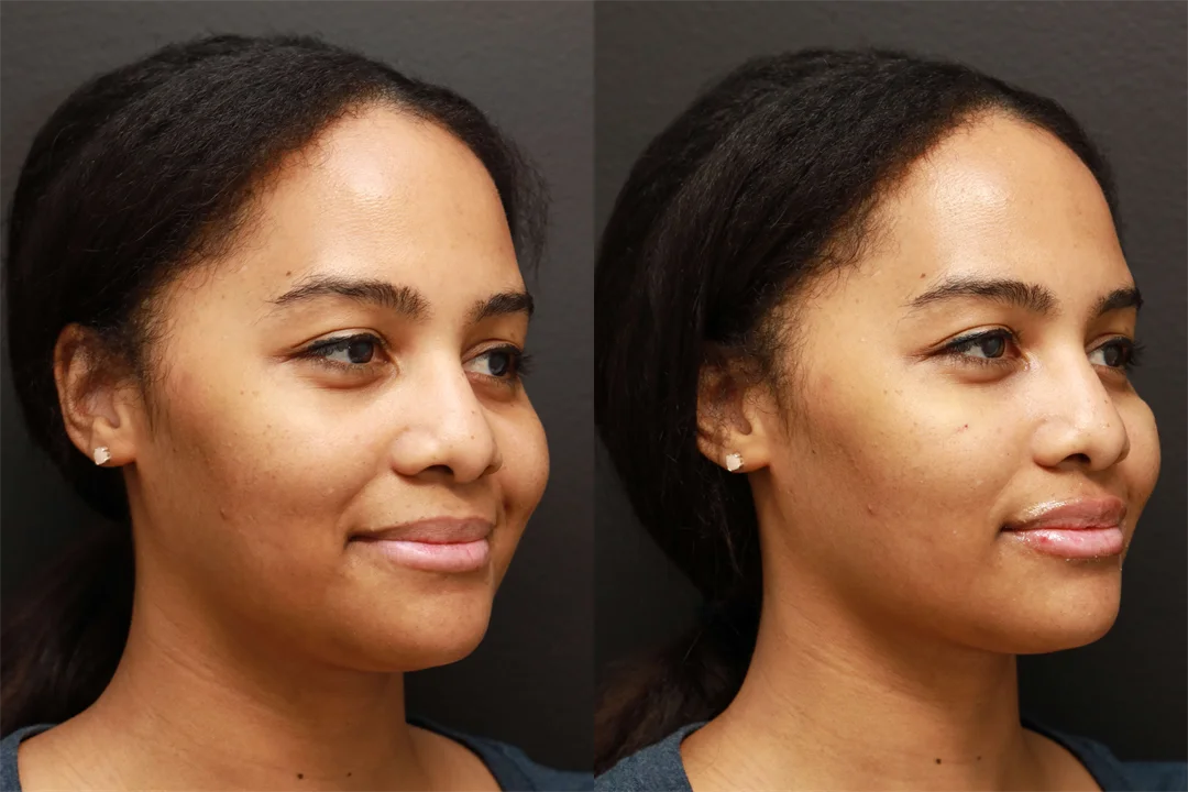 68693-Right Oblique combined