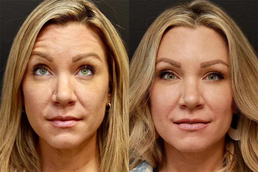71325-AP Eyebrows Raised combined