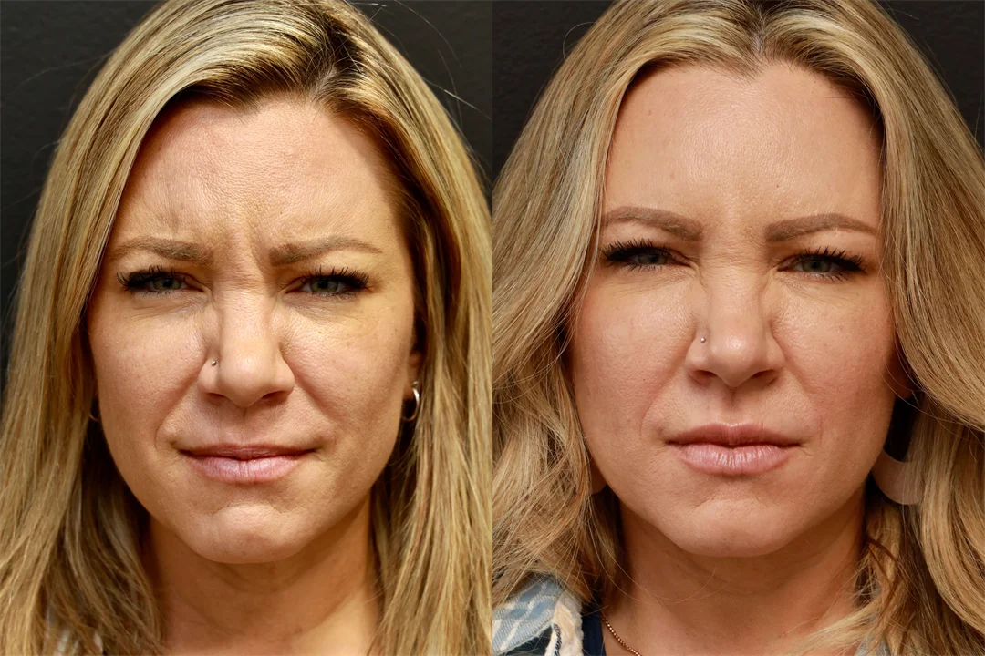 71325-AP Frown combined