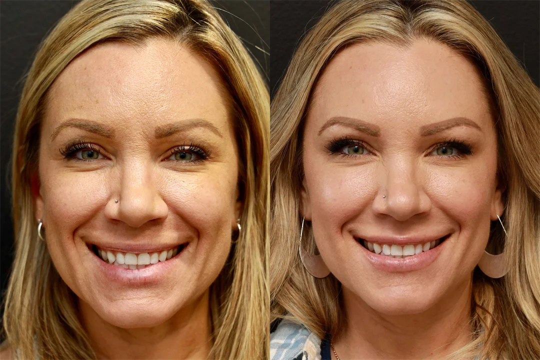 71325-AP Smiling combined