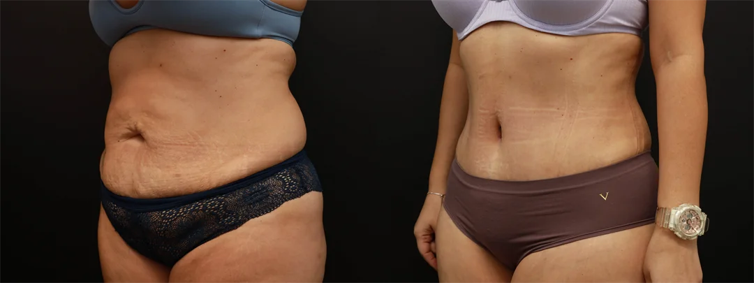 71459-Left Oblique combined