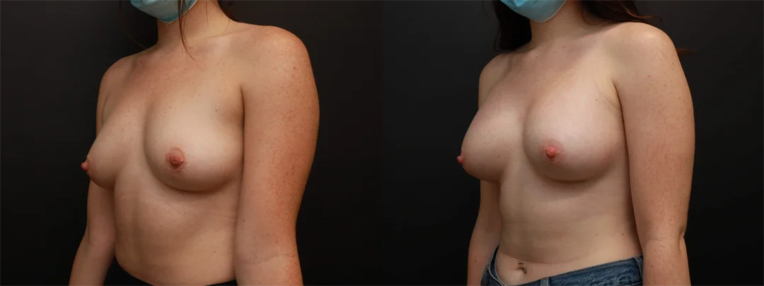 72373-Left Oblique combined