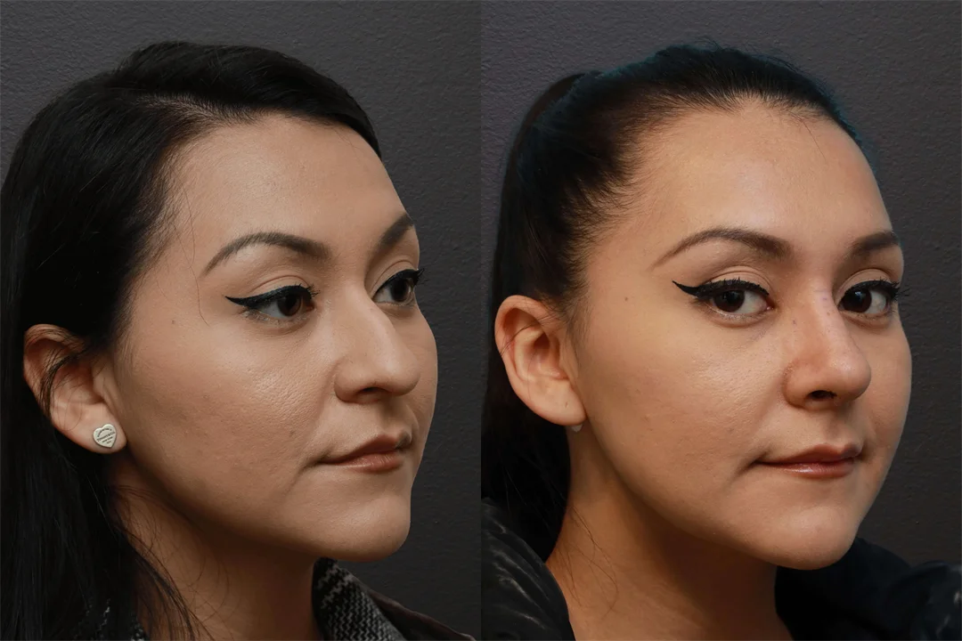 72496-Right Oblique combined