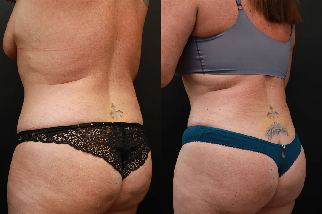 72545-Left Back Oblique Before