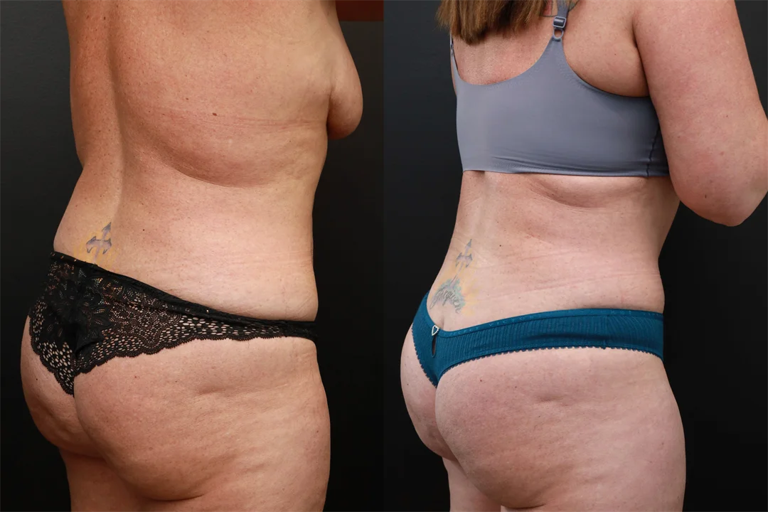 72545-Right Back Oblique Before