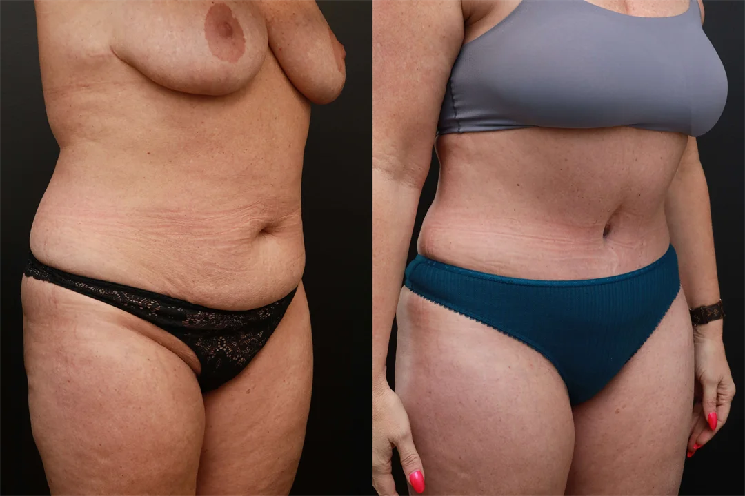 72545-Right Oblique Before