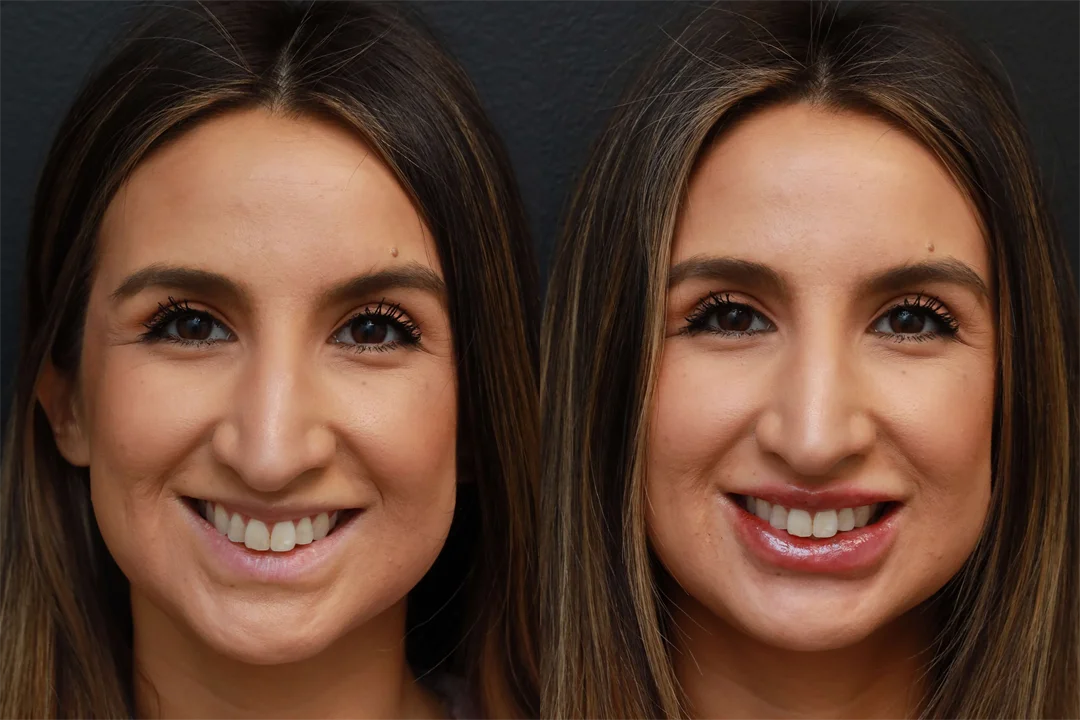 72629-AP Smiling combined