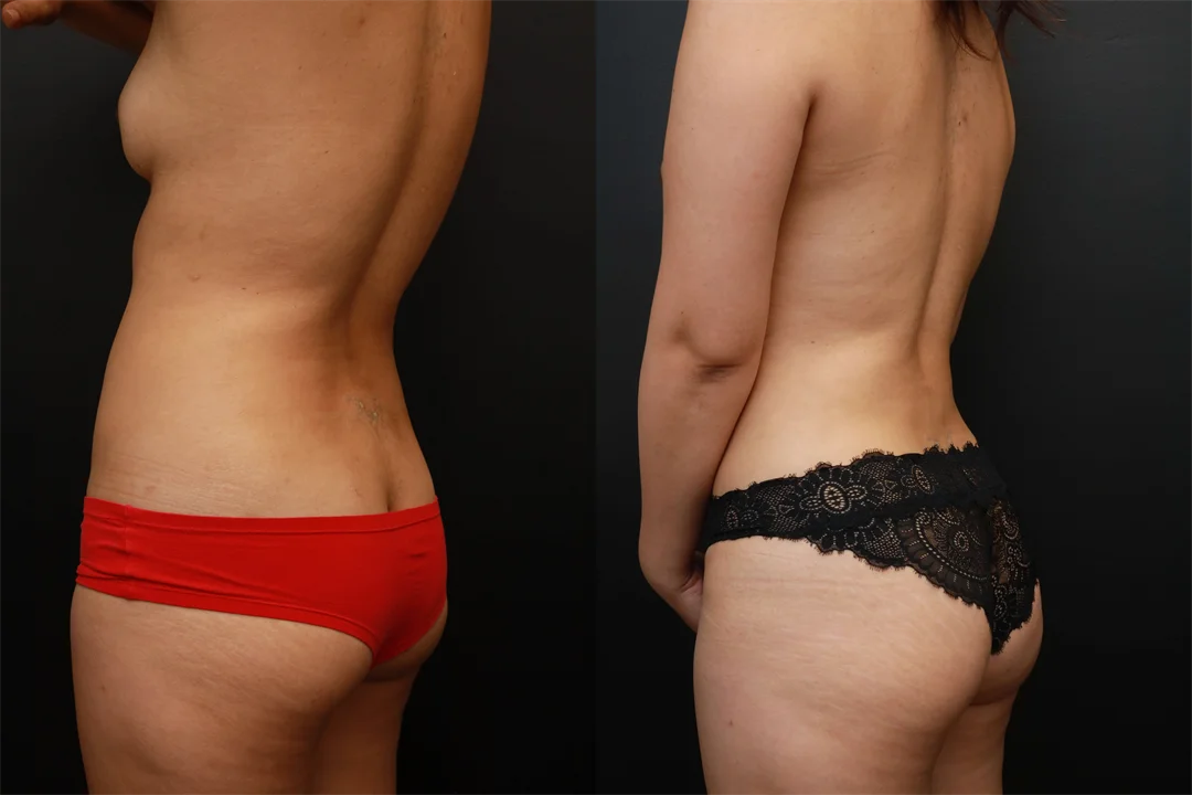 73454-Left Oblique Posterior combined