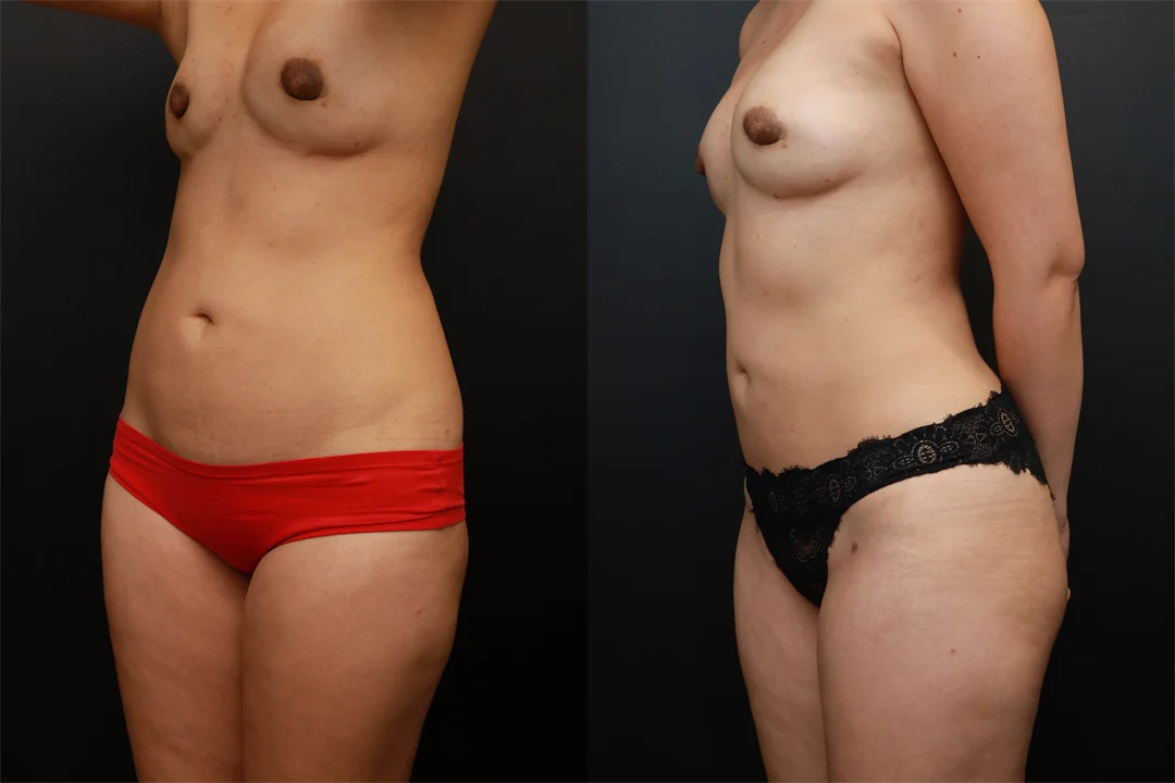 73454-Left Oblique combined