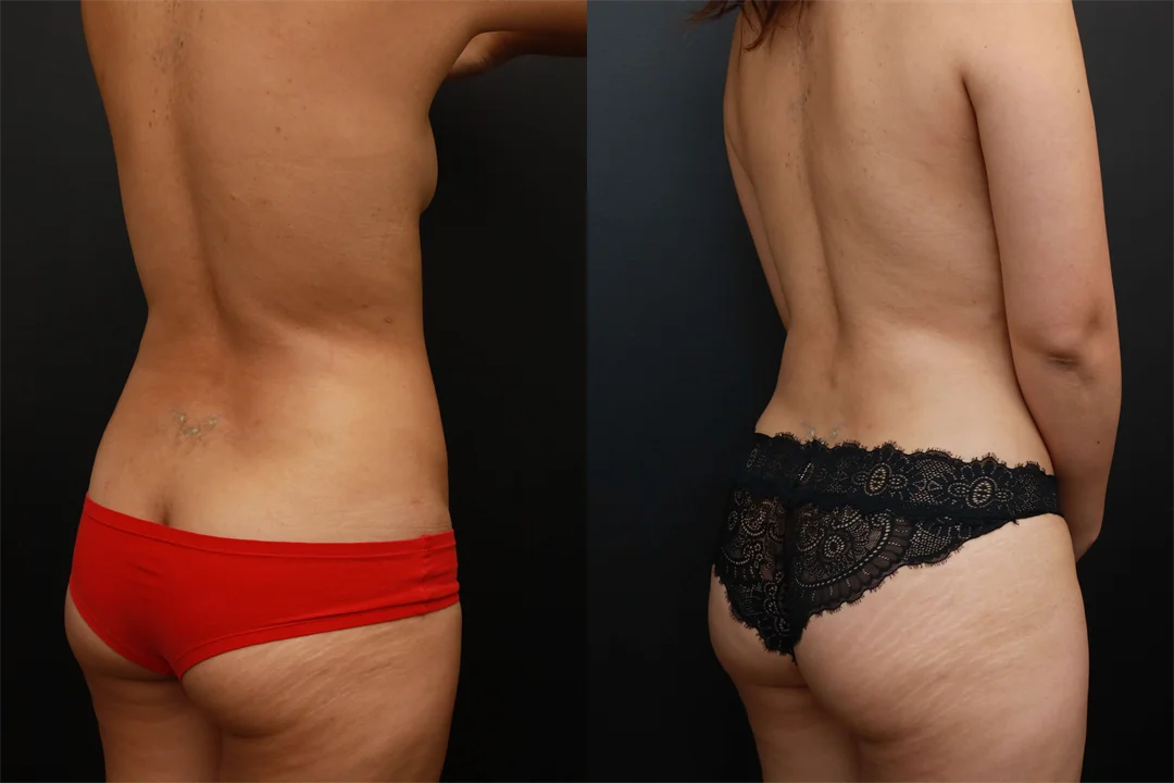 73454-Right Oblique Posterior combined
