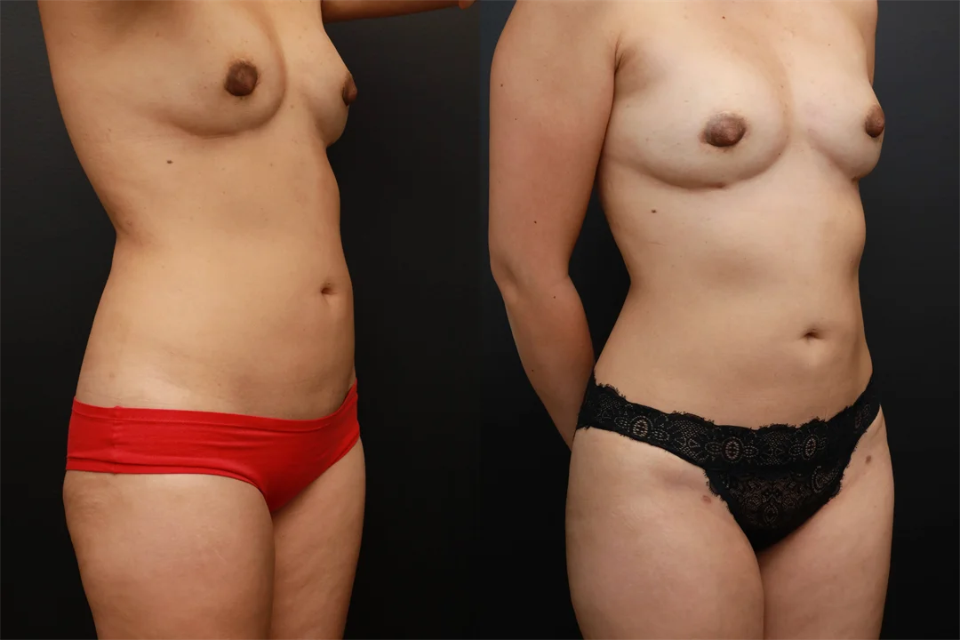 73454-Right Oblique combined