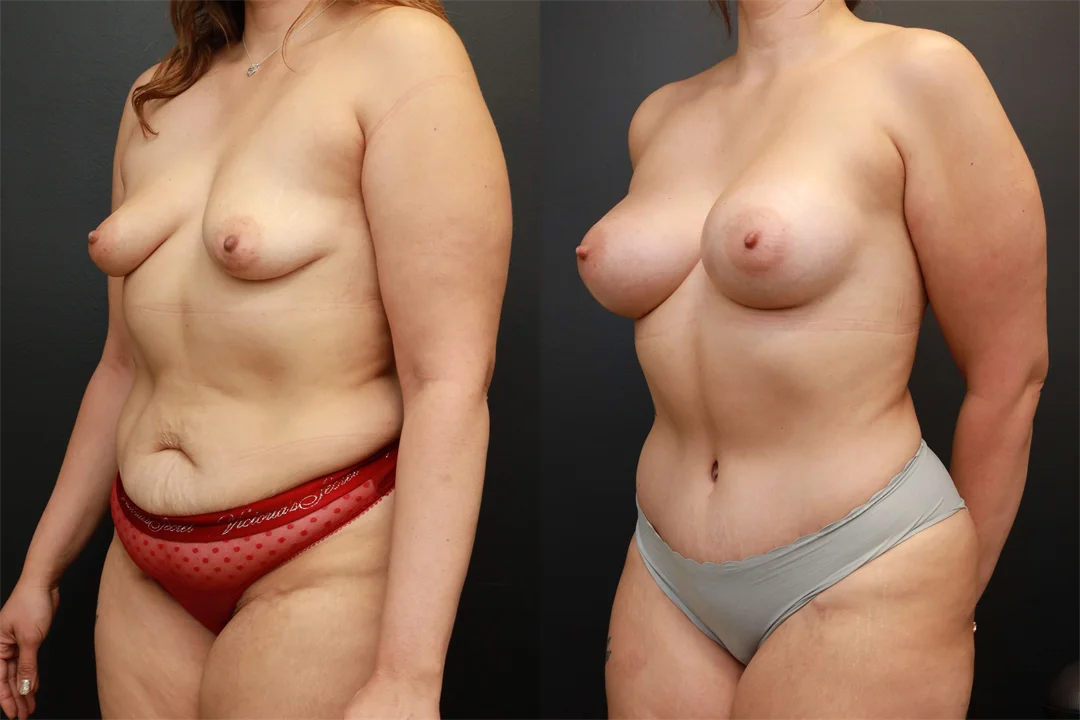 73914-Left Oblique Before