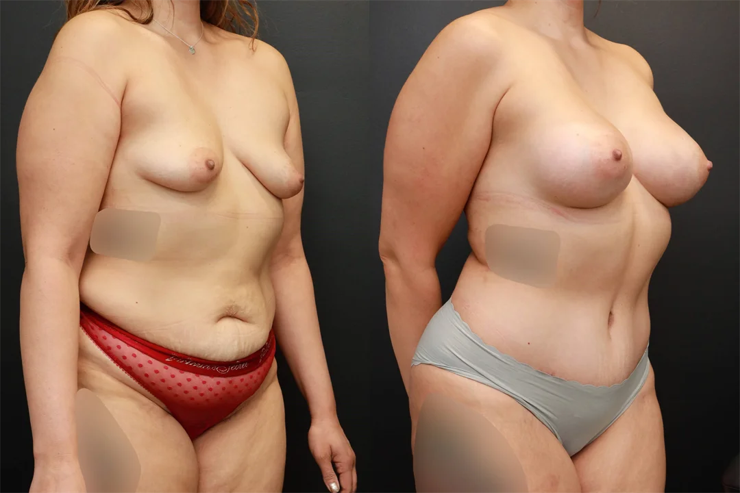 73914-Right Oblique Before