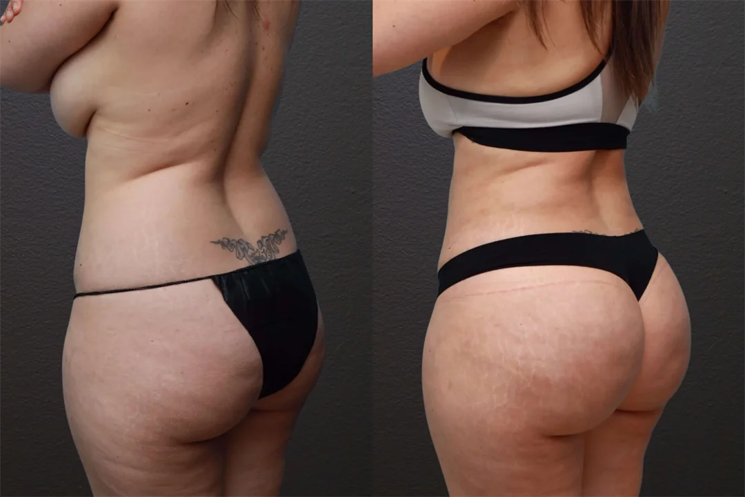 74204-Left Oblique combined