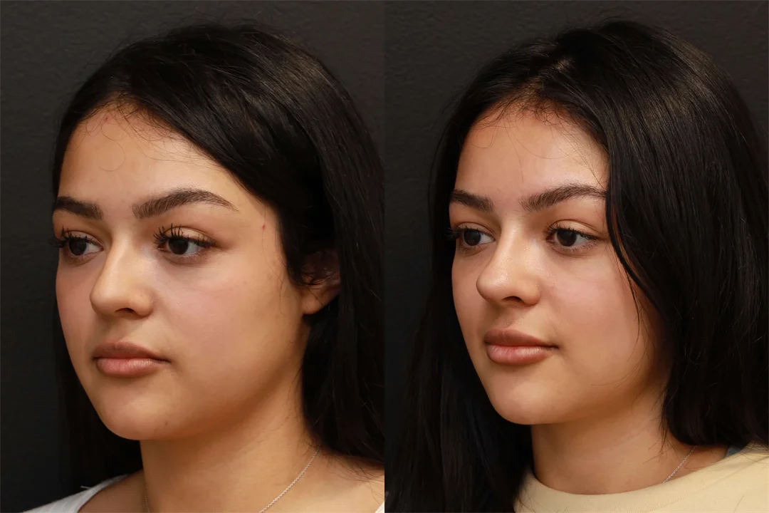 74662-Left Oblique combined