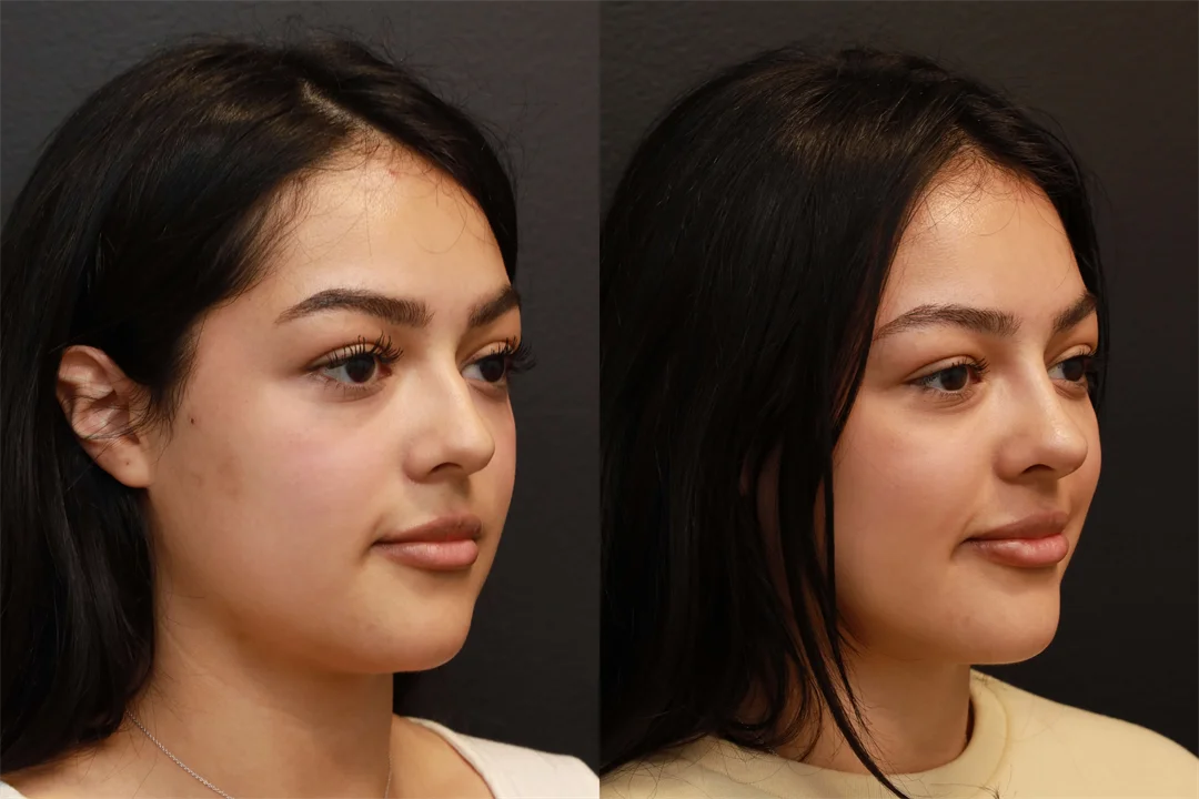 74662-Right Oblique combined