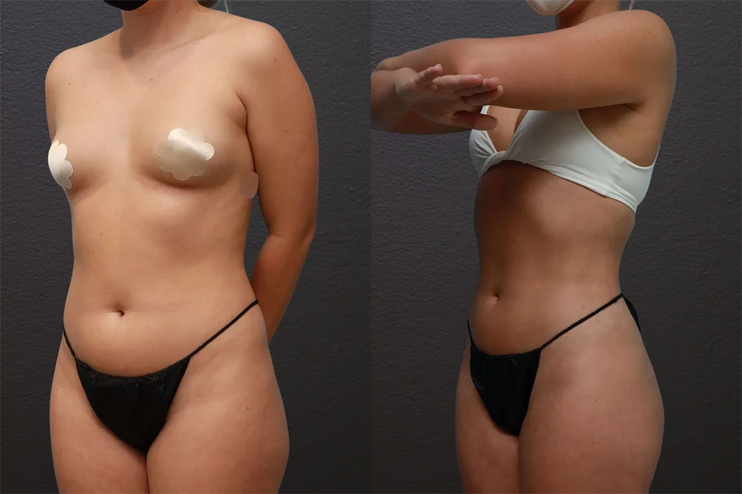 75159-Left Oblique combined