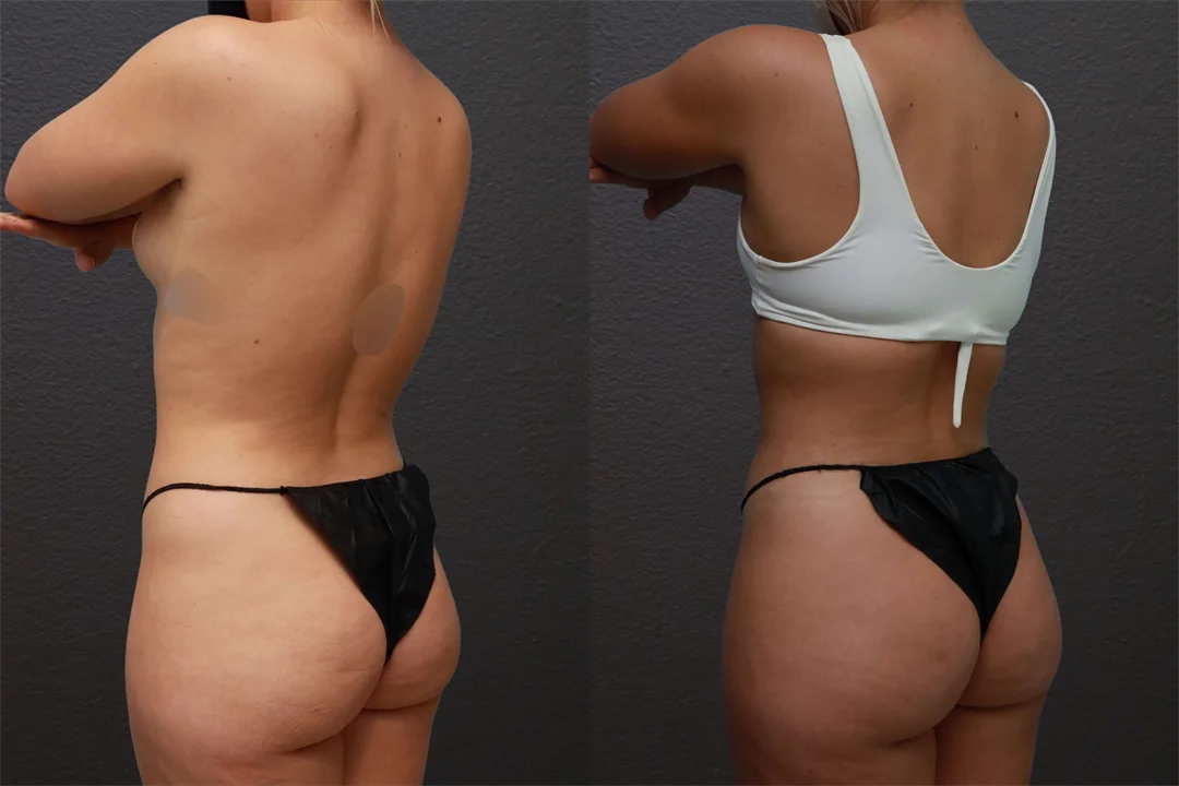75159-Left Posterior Oblique combined