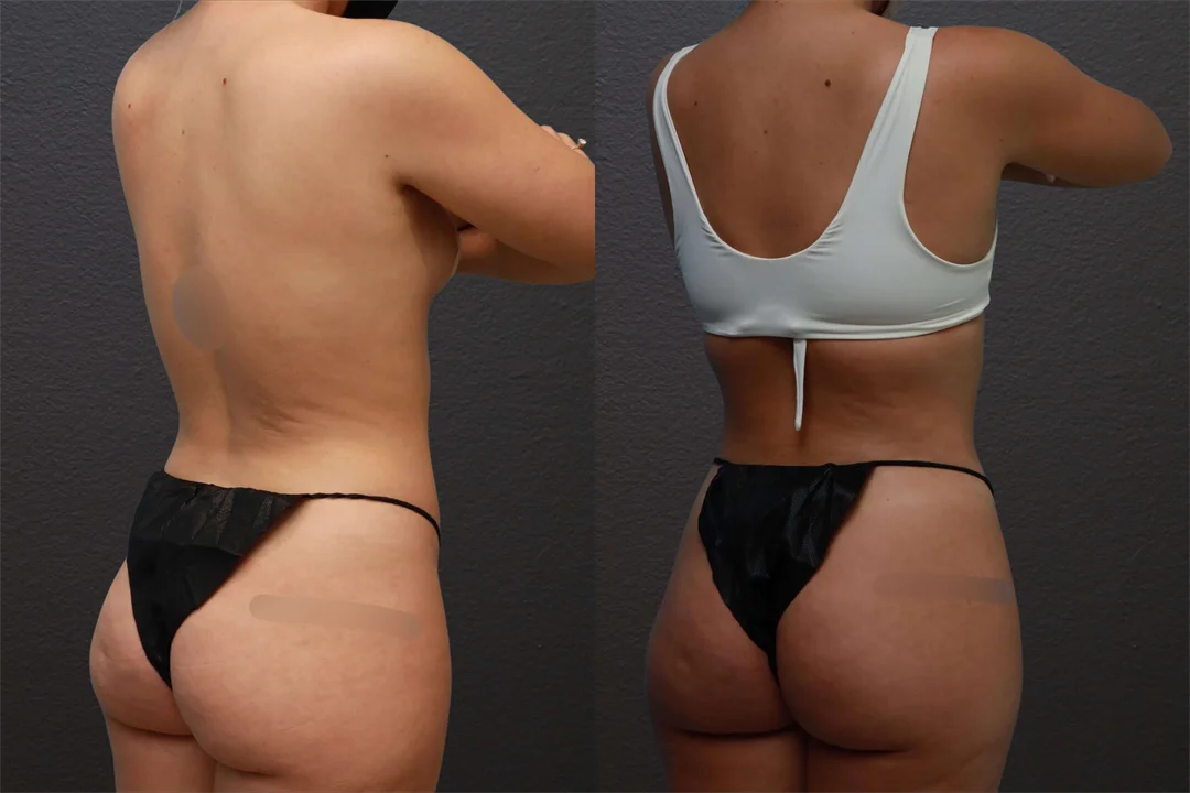 75159-Right Anterior Oblique combined