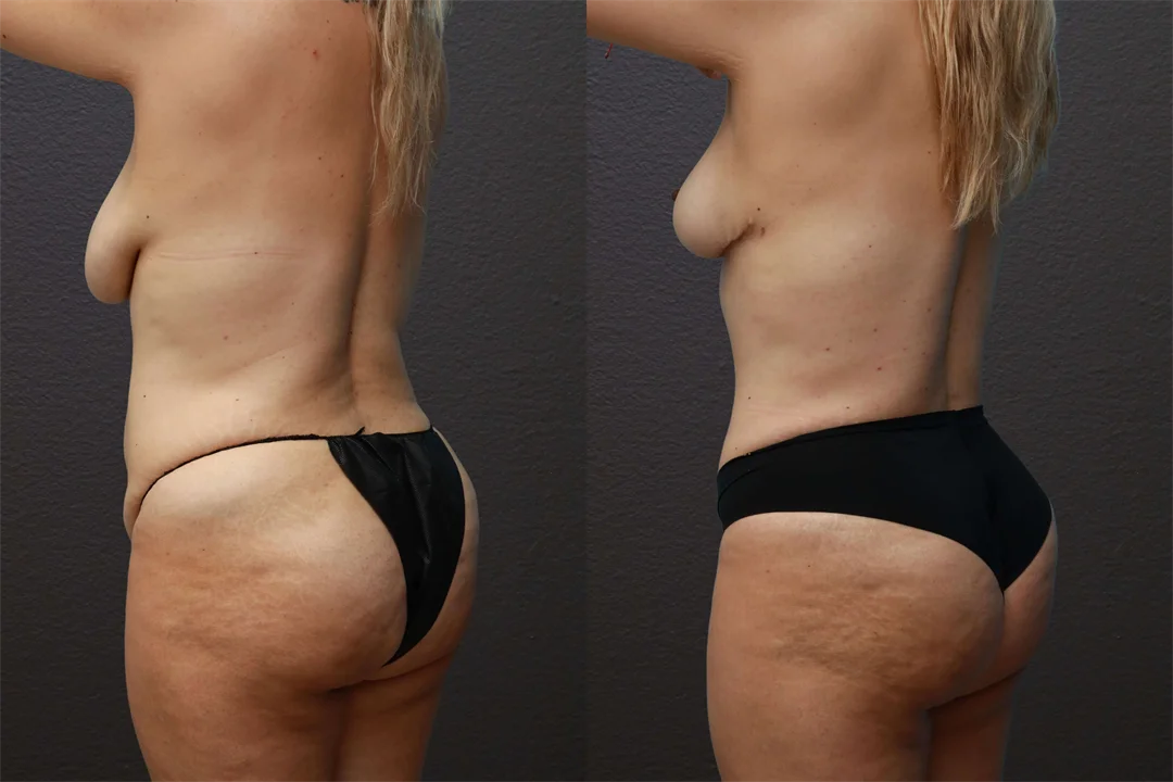 75557-Left Back Oblique Before