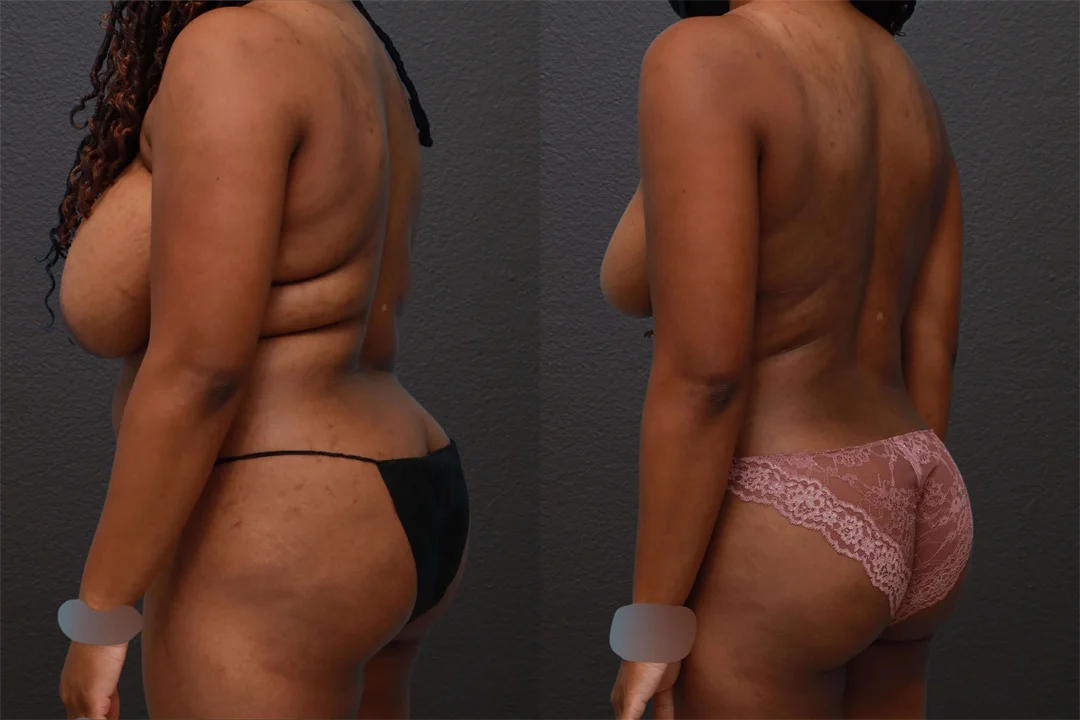 76087-Left Back Oblique Before