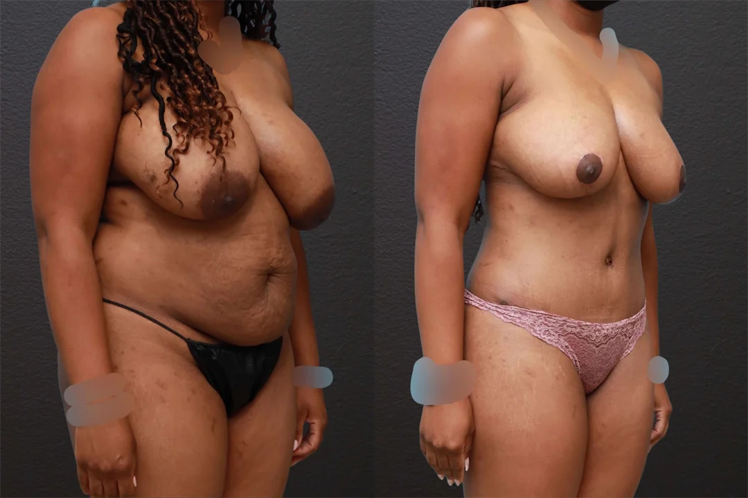 76087-Right Oblique Before