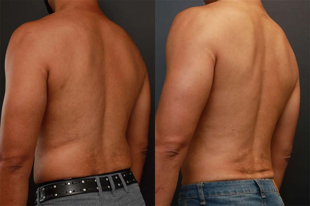 76130-Left Back Oblique combined