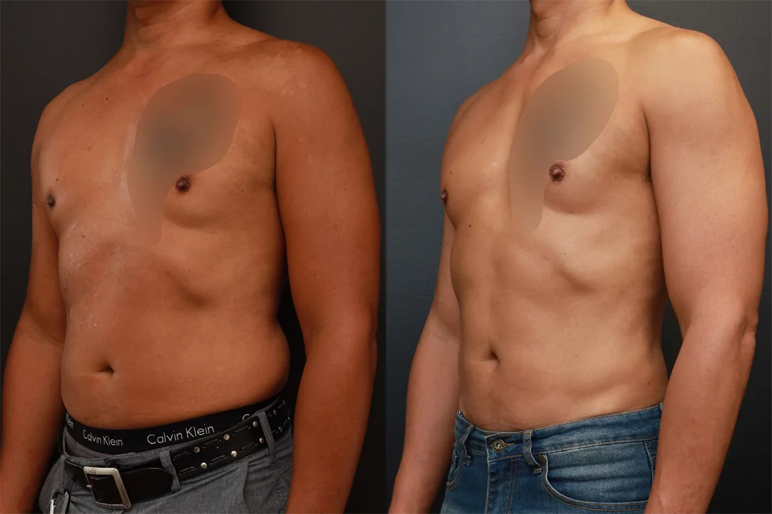 76130-Left Oblique combined
