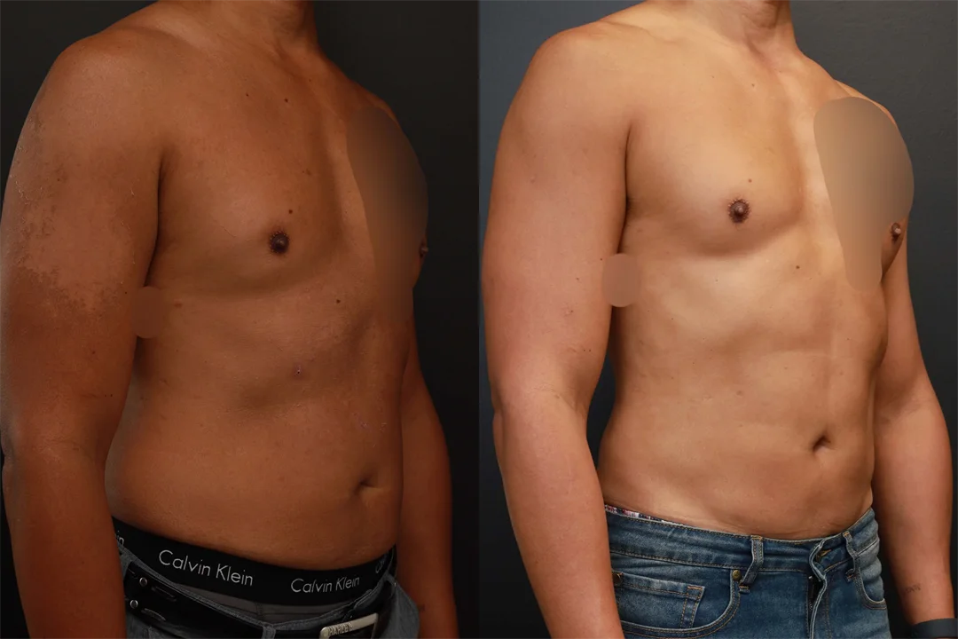 76130-Right Oblique combined