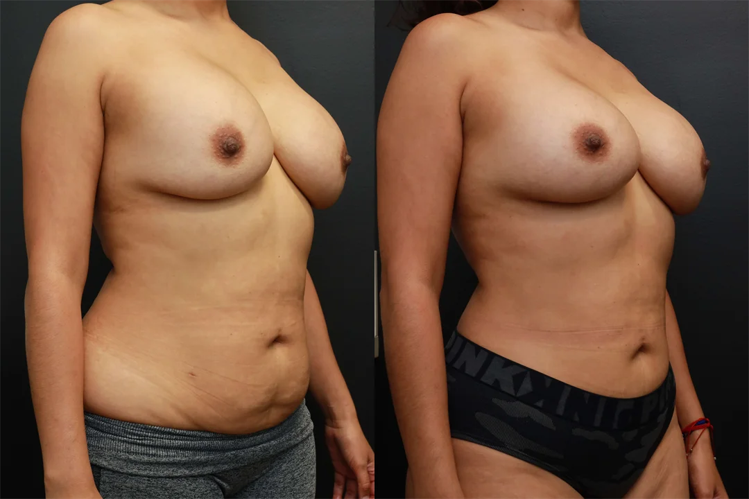 76328-Right Oblique combined