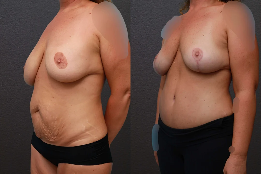 76446-Left Oblique combined