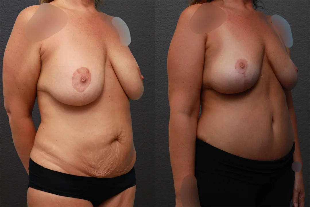 76446-Right Oblique combined