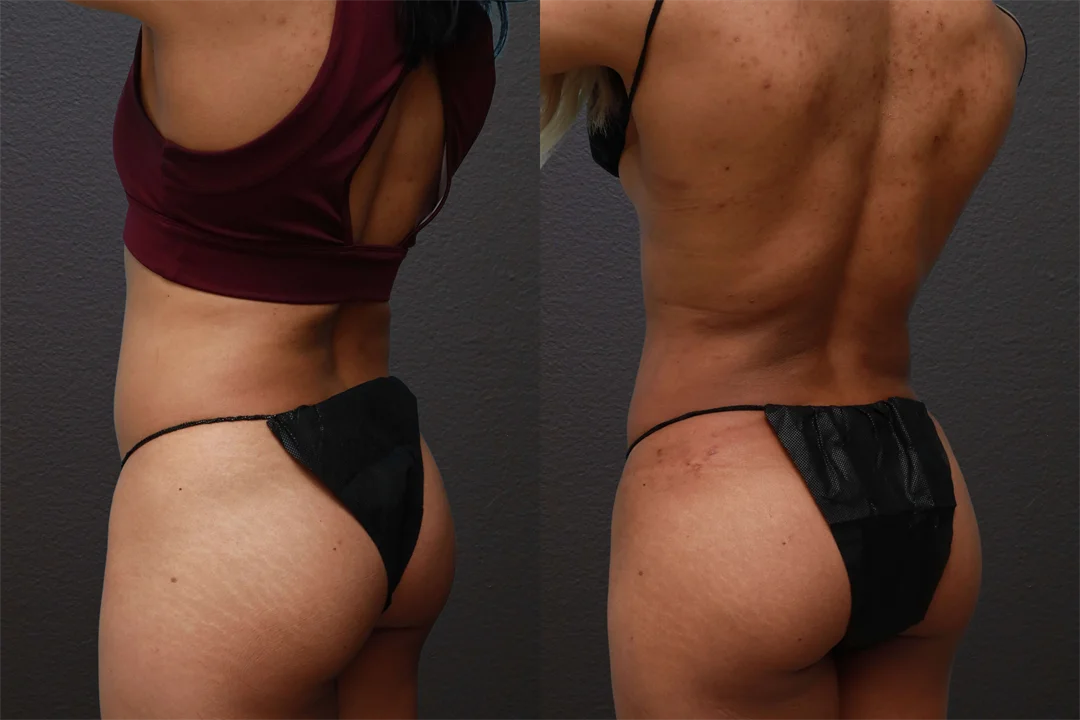 76570-Left Back Oblique combined