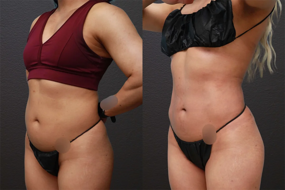 76570-Left Oblique combined