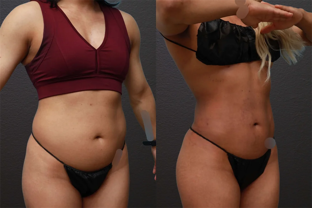 76570-Right Oblique combined