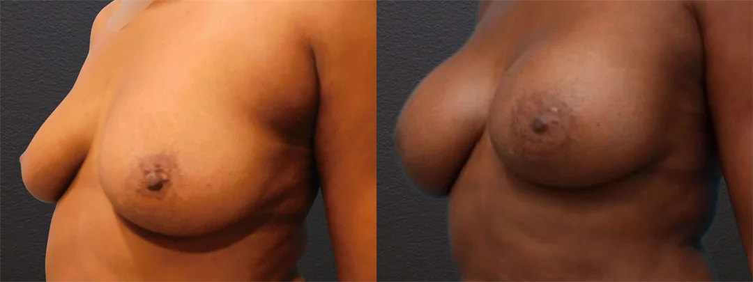 76644-Left Oblique combined
