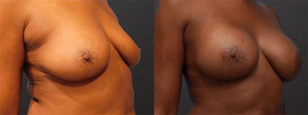 76644-Right Oblique combined