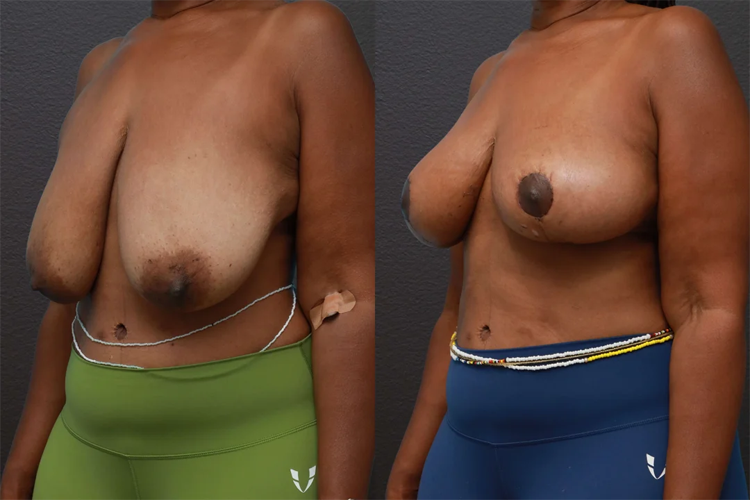 77891-Left Oblique combined