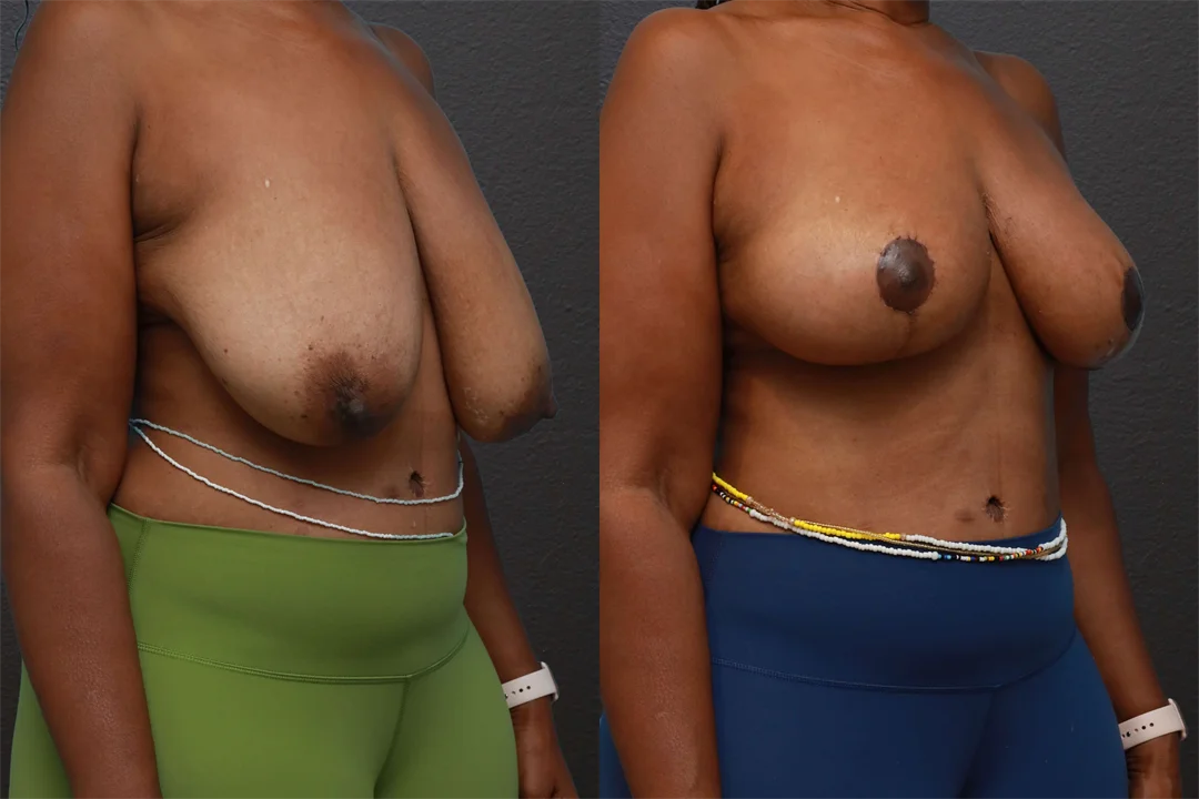 77891-Right Oblique combined
