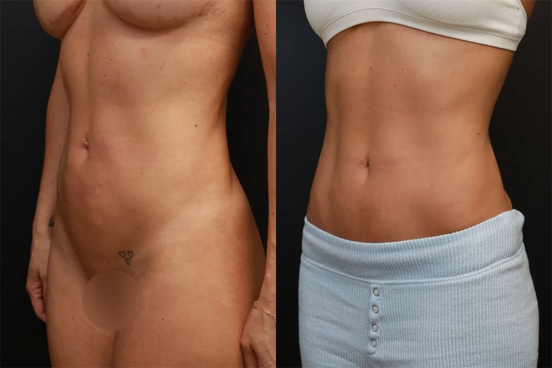 78522-Left Oblique Before