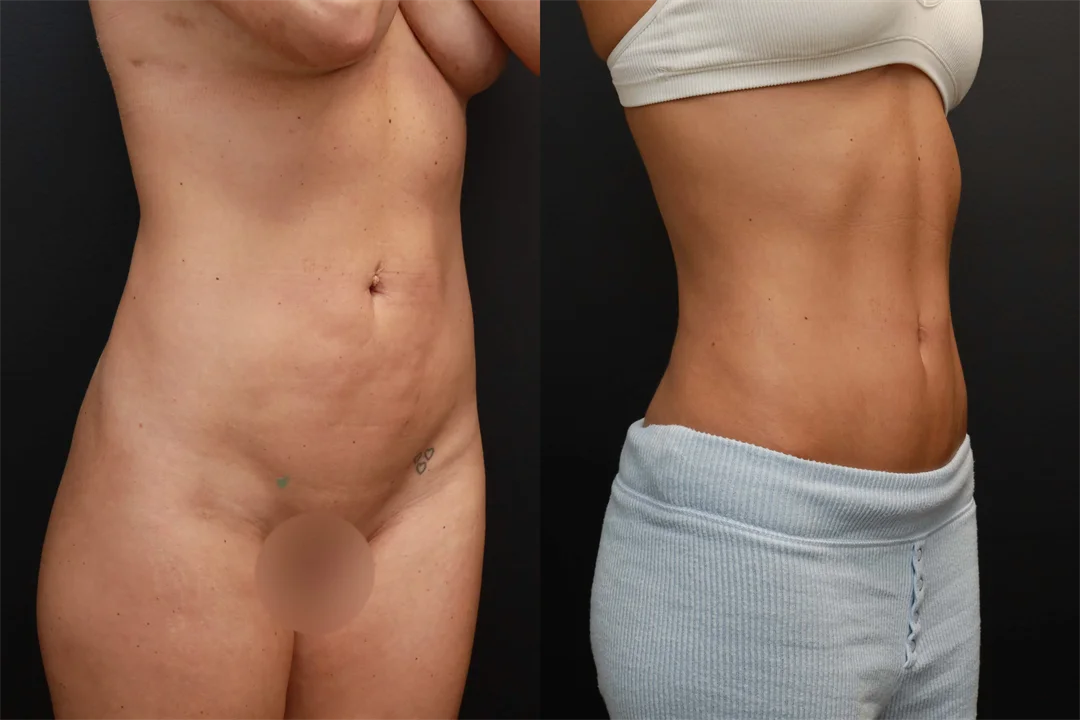 78522-Right Oblique Before