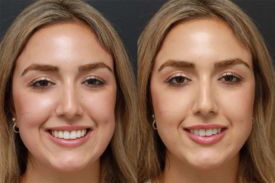 78979-AP Smiling combined