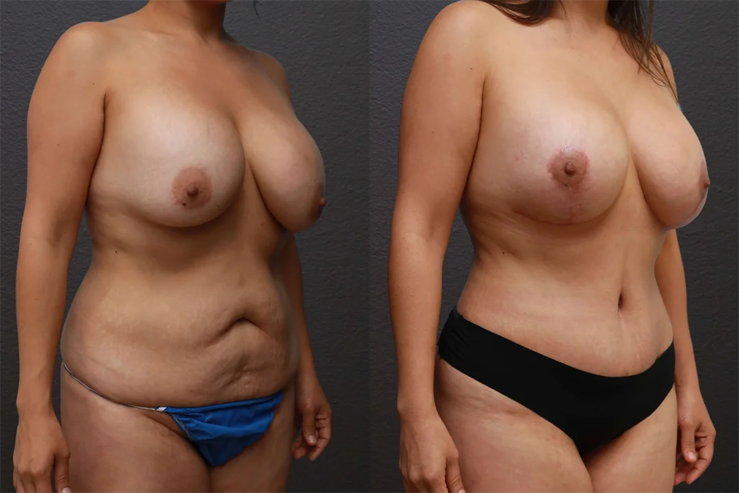 79673-Right Oblique combined